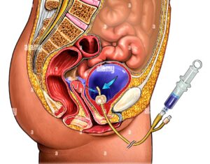 sonde urinaire 2 (2)