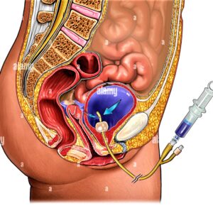 sonde urinaire 2 (2)